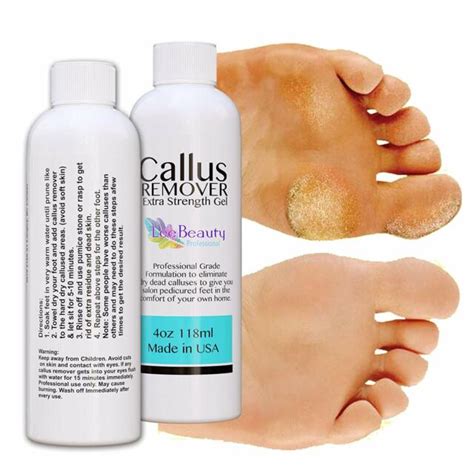 Say goodbye to calluses with the magic touch of the gel